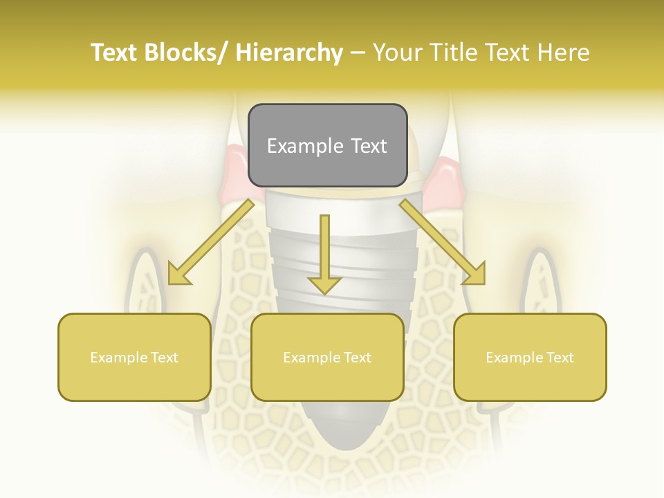 A Tooth With A Implant In The Middle Of It PowerPoint Template