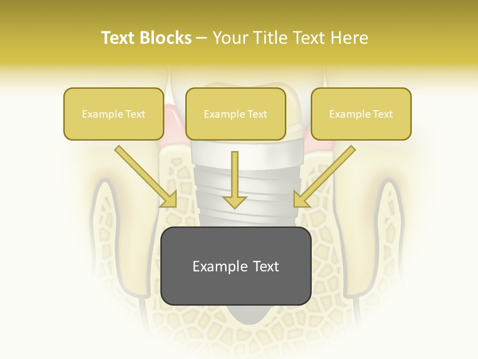 A Tooth With A Implant In The Middle Of It PowerPoint Template