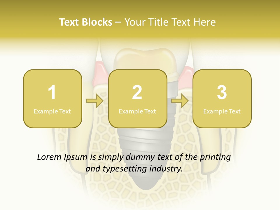 A Tooth With A Implant In The Middle Of It PowerPoint Template