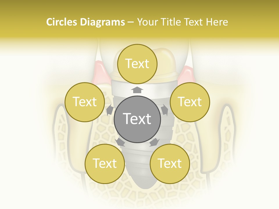 A Tooth With A Implant In The Middle Of It PowerPoint Template