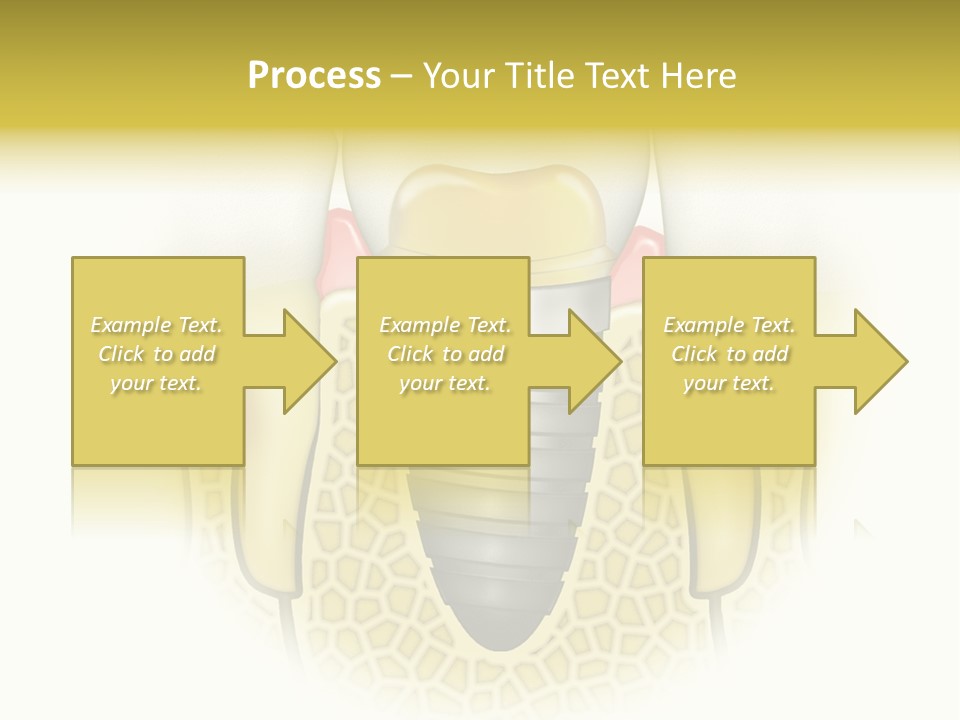 A Tooth With A Implant In The Middle Of It PowerPoint Template