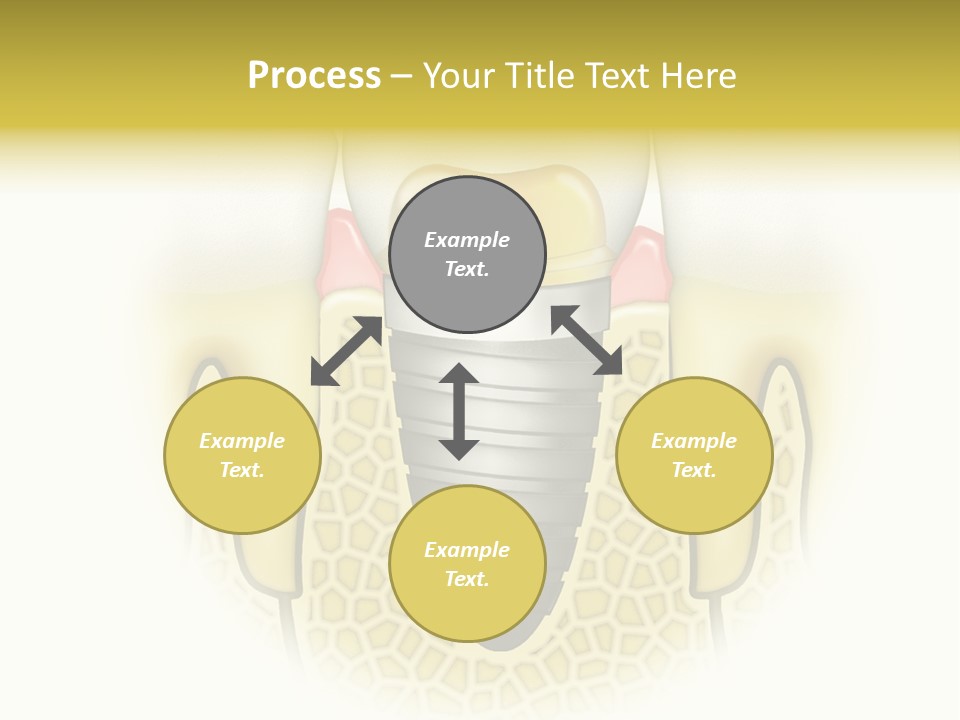 A Tooth With A Implant In The Middle Of It PowerPoint Template