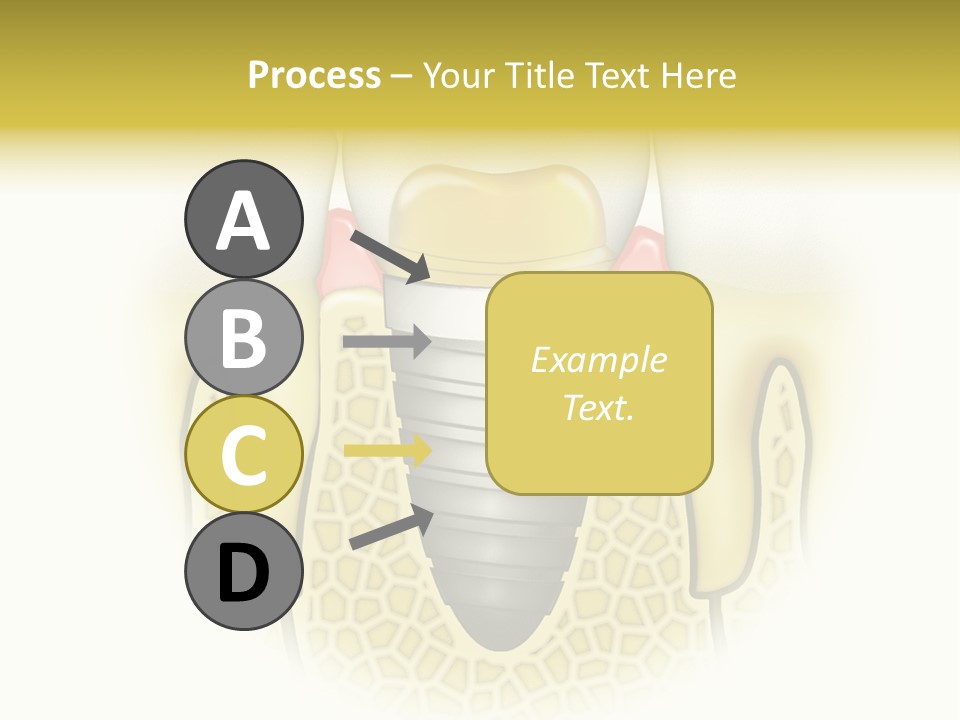 A Tooth With A Implant In The Middle Of It PowerPoint Template