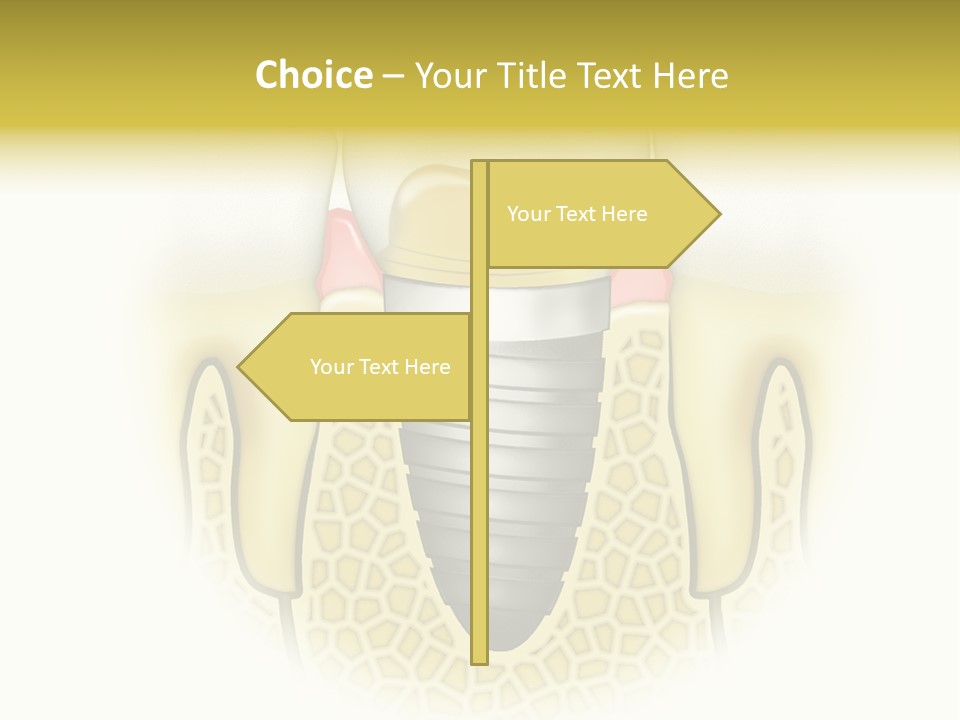 A Tooth With A Implant In The Middle Of It PowerPoint Template