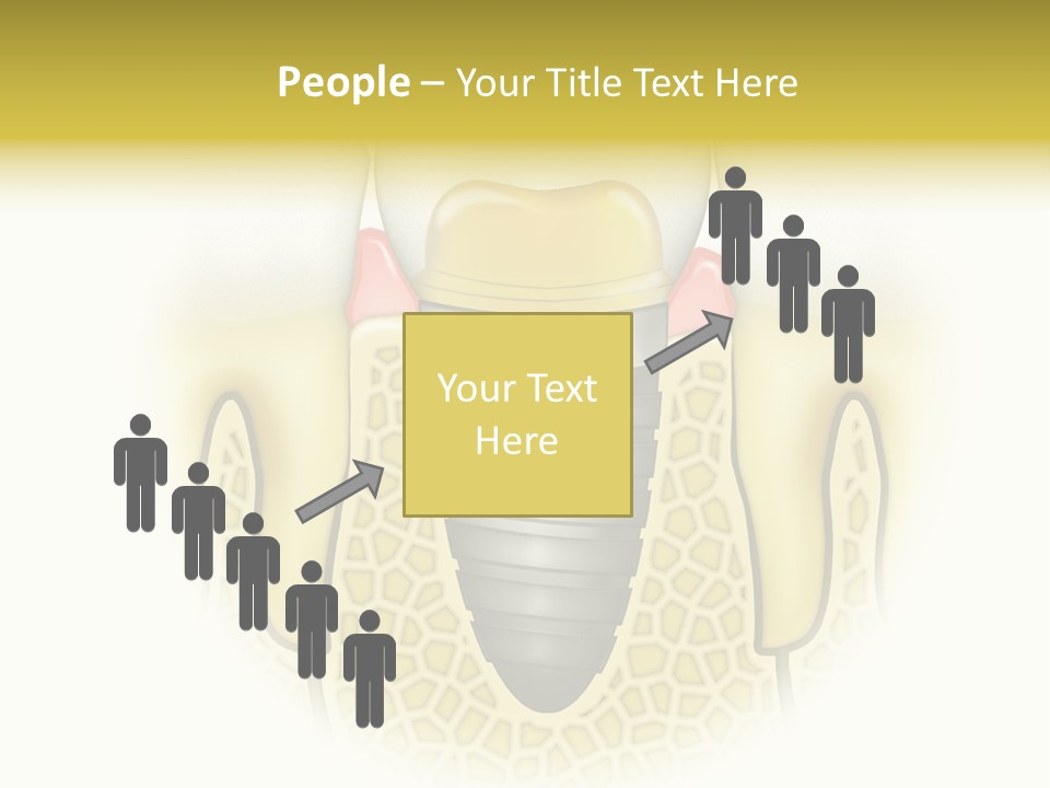A Tooth With A Implant In The Middle Of It PowerPoint Template