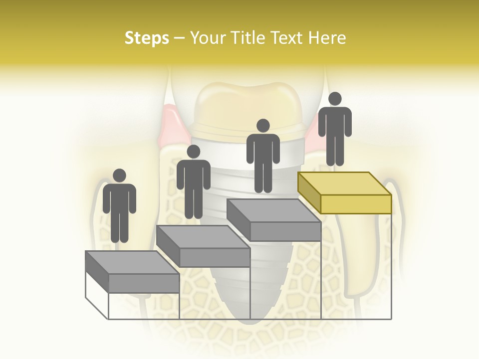 A Tooth With A Implant In The Middle Of It PowerPoint Template