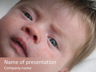 Baby With Rash PowerPoint Template