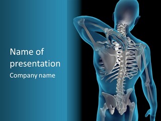 People Graphic Osteoporosis PowerPoint Template