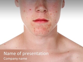 Irritation Young Youth PowerPoint Template