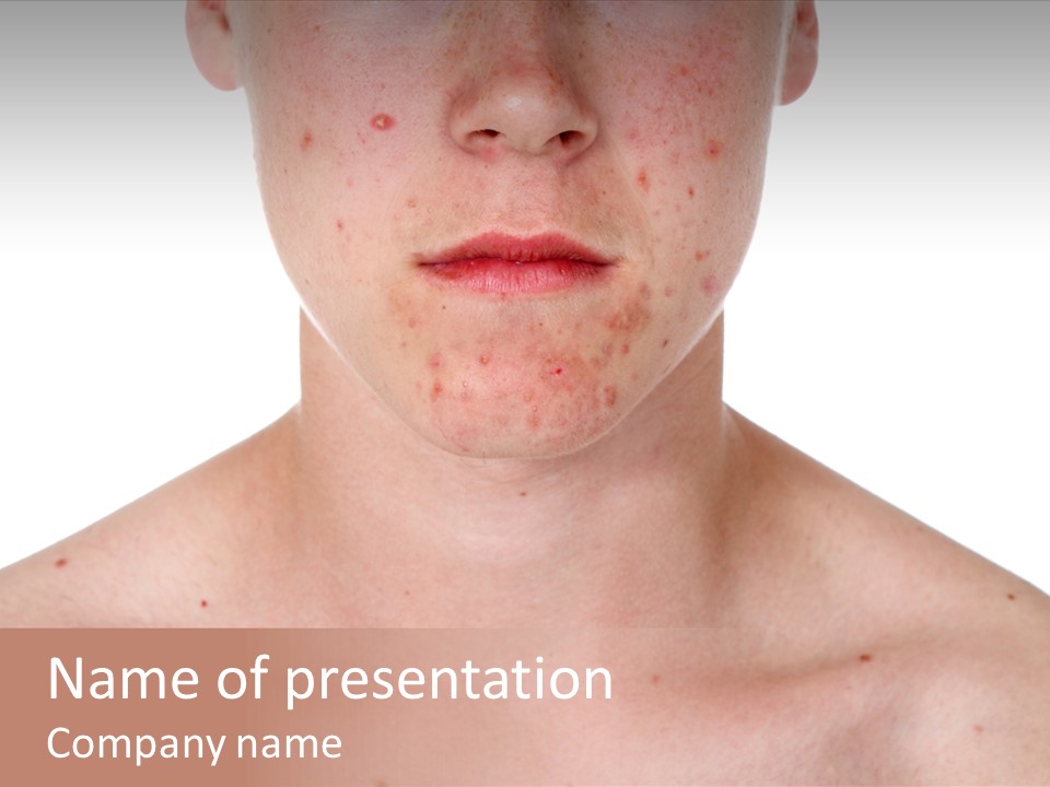 Irritation Young Youth PowerPoint Template