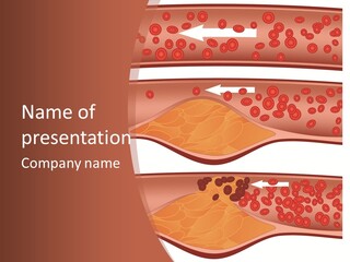 Cardiology Angina Myocardial Infarction PowerPoint Template