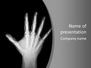 Skeleton Finger Broken PowerPoint Template