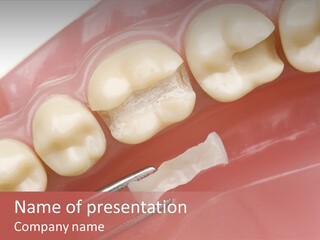 Periodontosis Dentist Ceramics PowerPoint Template