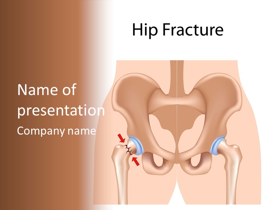 Injured Hip Illustration PowerPoint Template