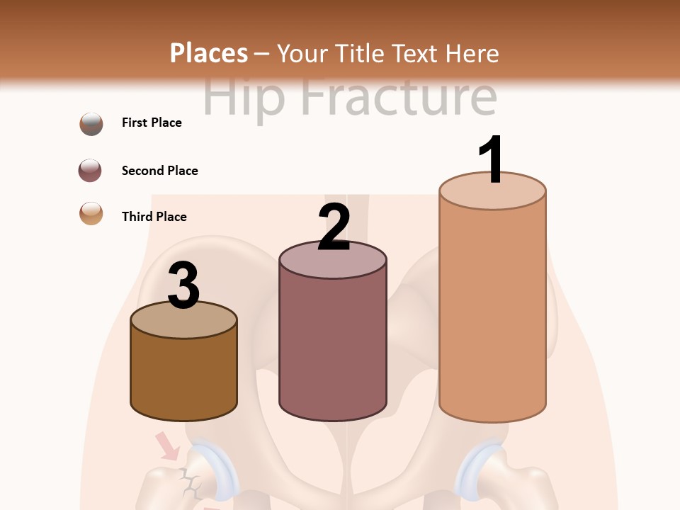 Injured Hip Illustration PowerPoint Template