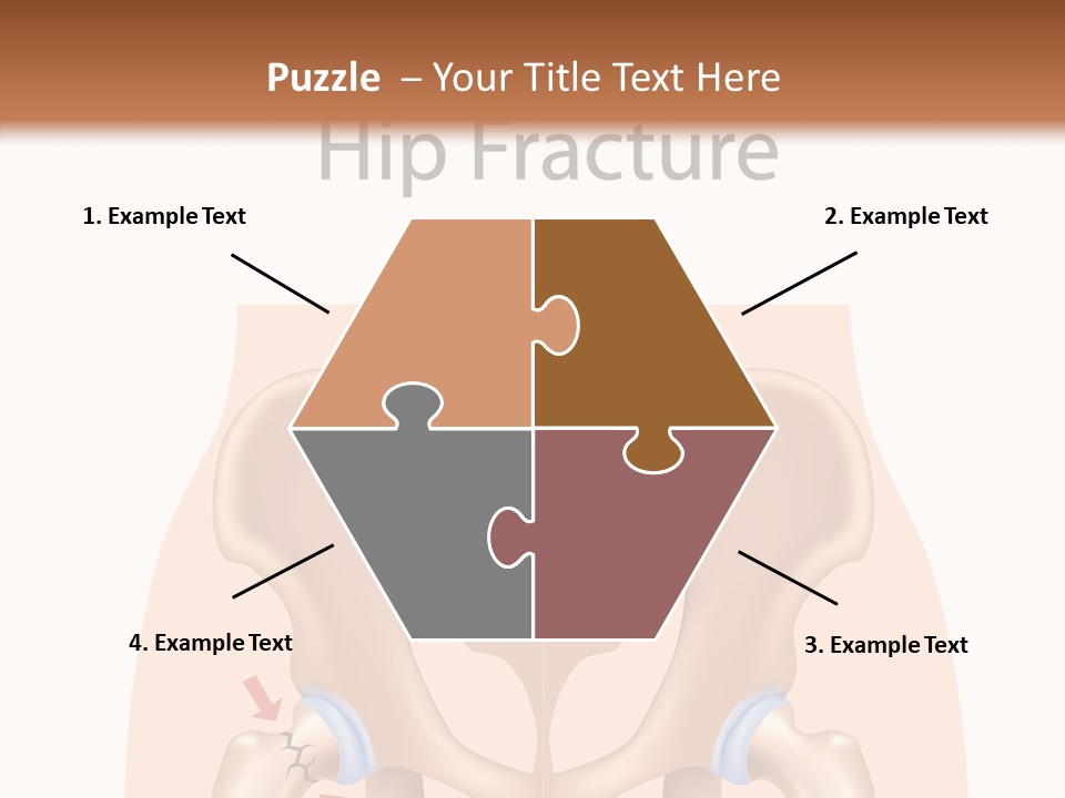 Injured Hip Illustration PowerPoint Template