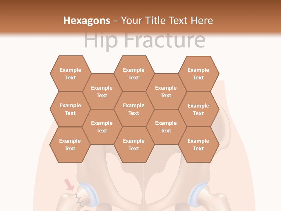 Injured Hip Illustration PowerPoint Template