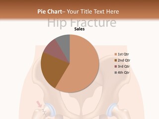 Injured Hip Illustration PowerPoint Template