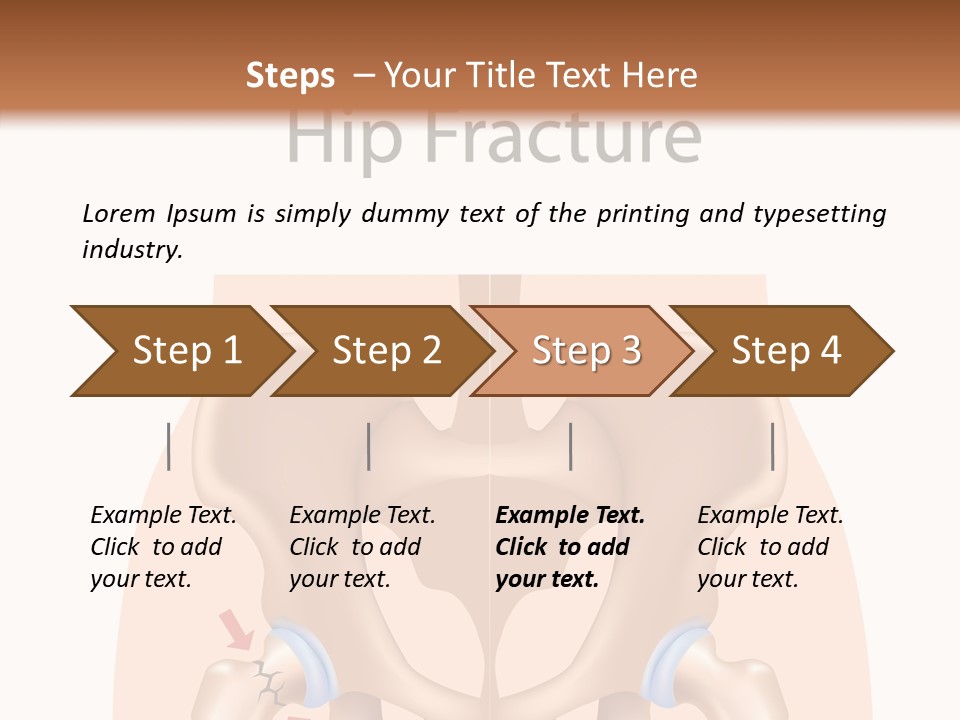 Injured Hip Illustration PowerPoint Template