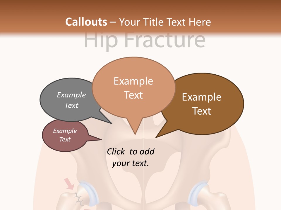 Injured Hip Illustration PowerPoint Template