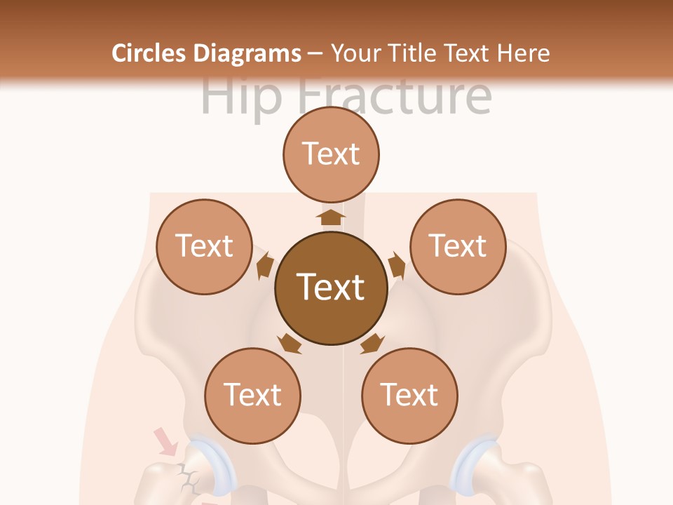 Injured Hip Illustration PowerPoint Template