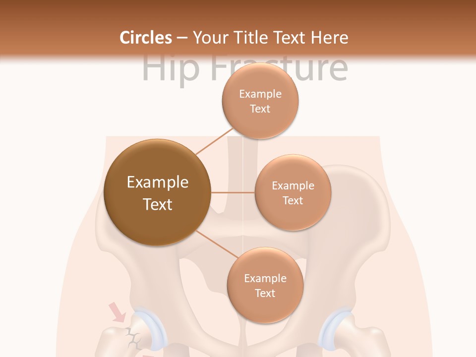 Injured Hip Illustration PowerPoint Template
