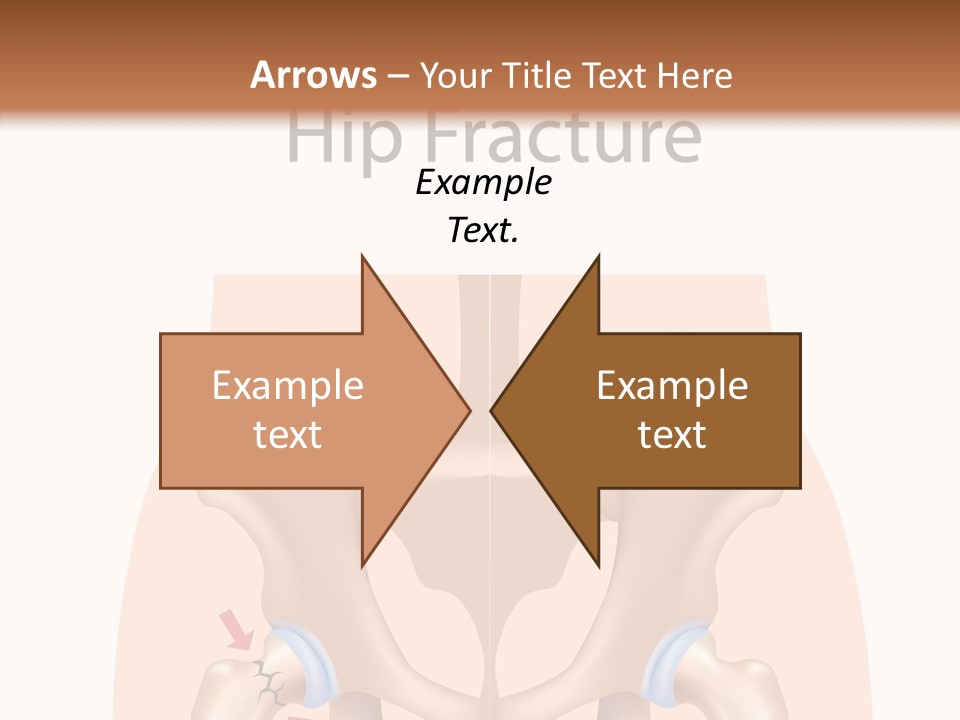 Injured Hip Illustration PowerPoint Template