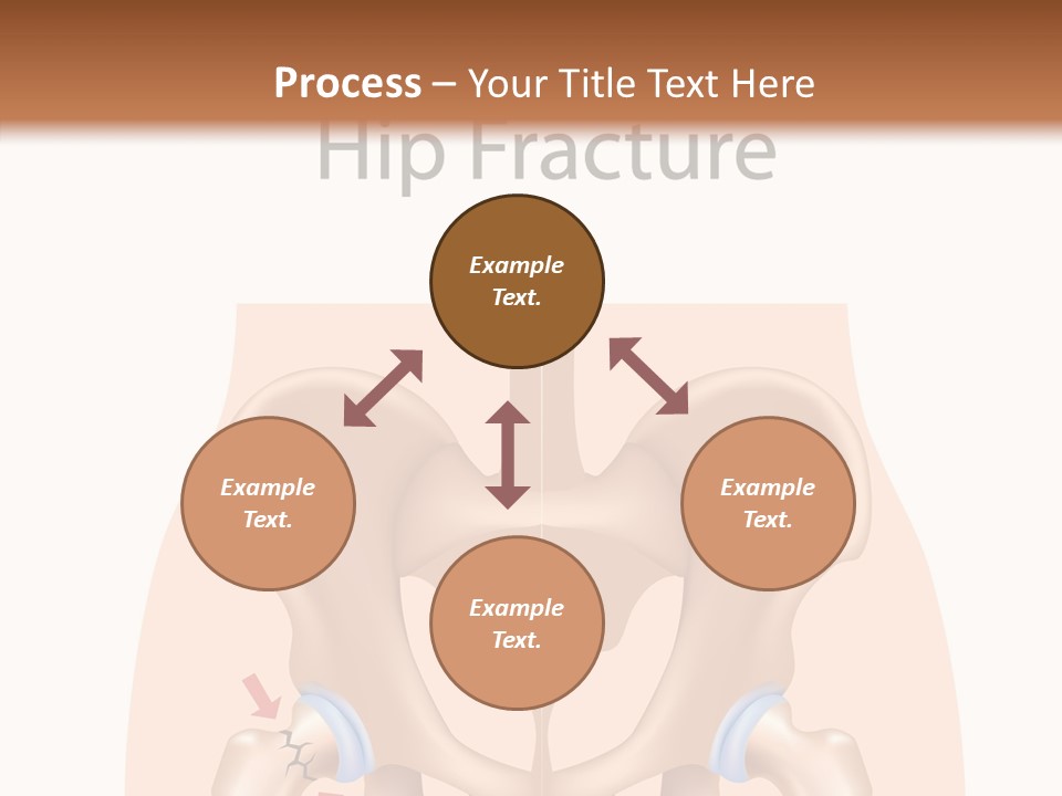 Injured Hip Illustration PowerPoint Template