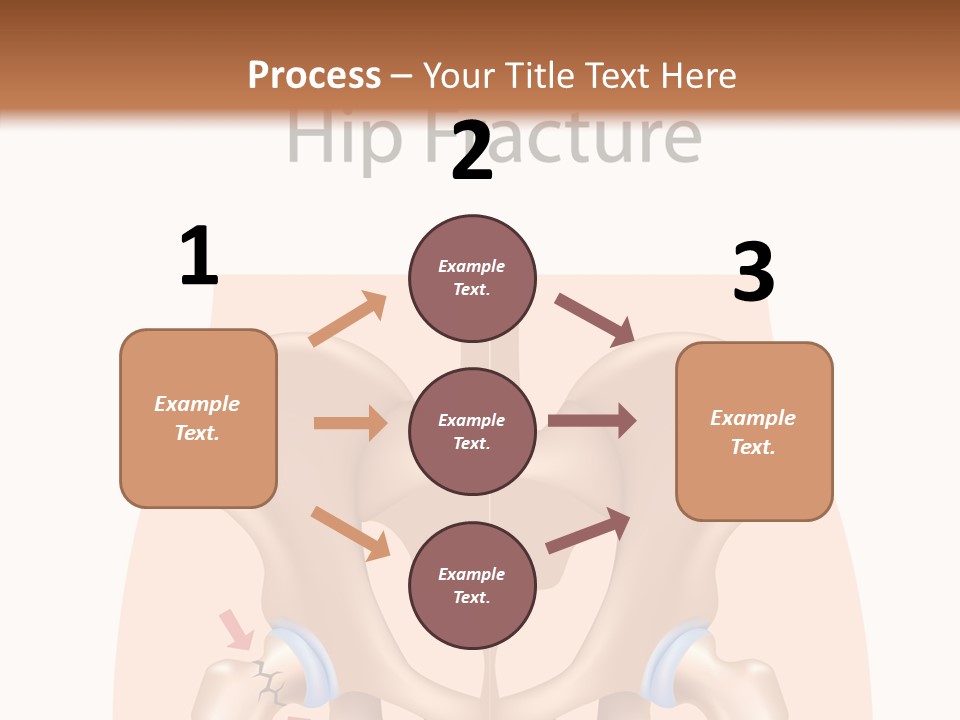 Injured Hip Illustration PowerPoint Template
