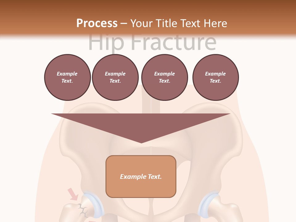 Injured Hip Illustration PowerPoint Template