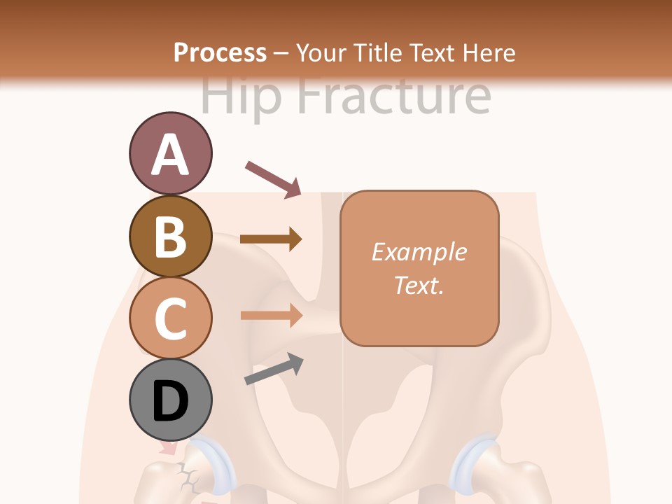 Injured Hip Illustration PowerPoint Template