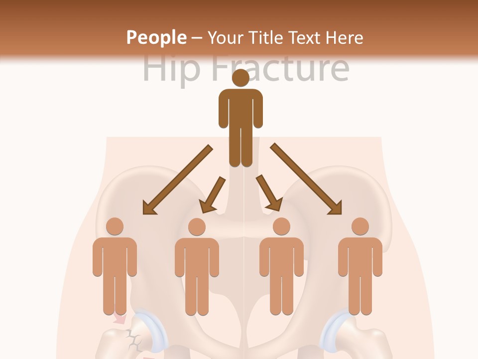 Injured Hip Illustration PowerPoint Template