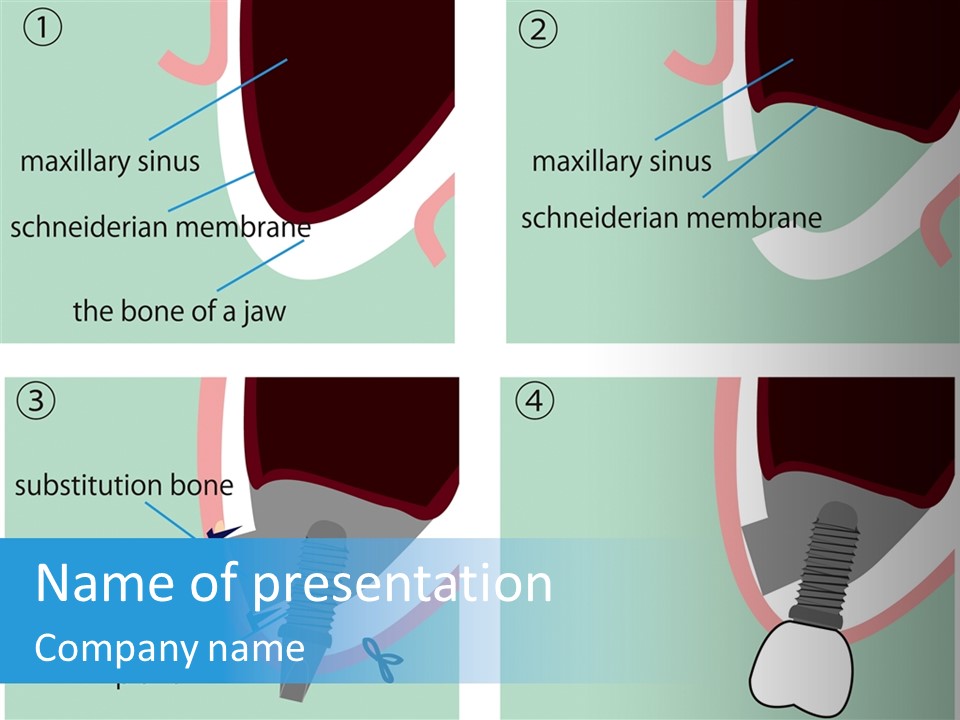 White Dentures Gingiva PowerPoint Template