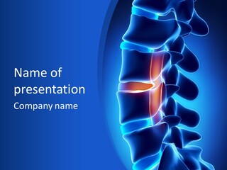 Bulging Bone Nerve PowerPoint Template