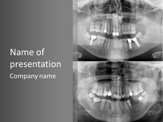 Examination Ceramic Jaw PowerPoint Template