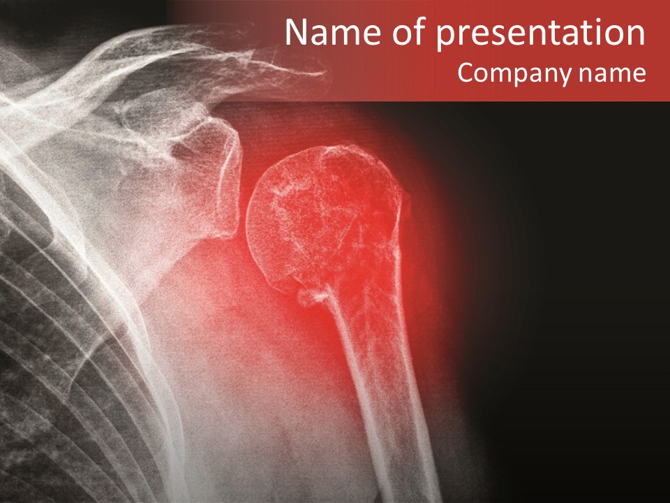 Medical Injury Humeral PowerPoint Template