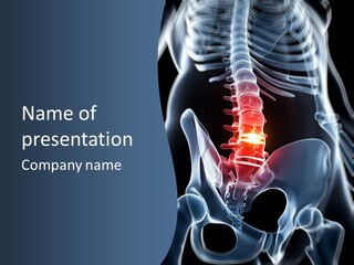 Prolapse Nerve Canal PowerPoint Template