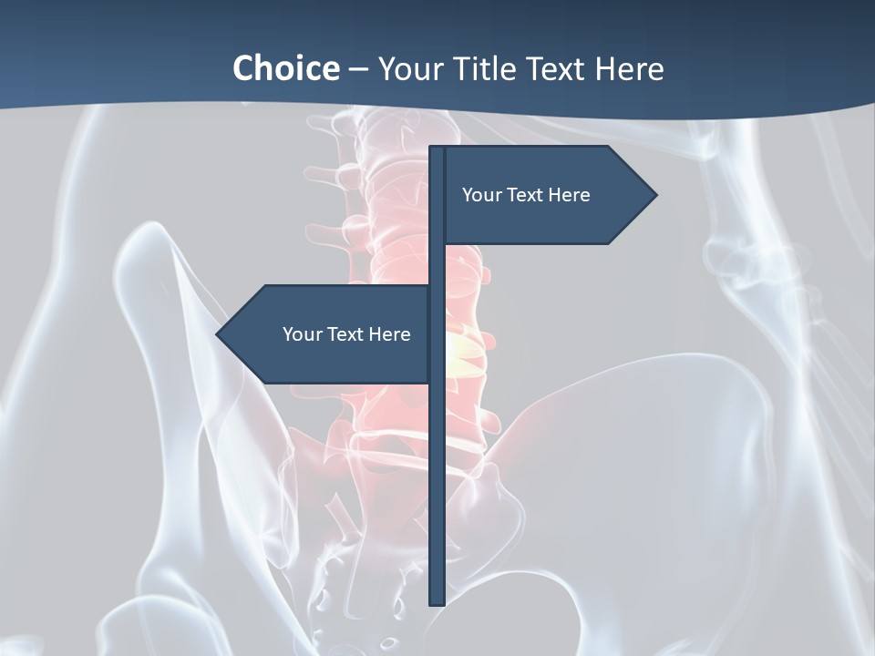 Prolapse Nerve Canal PowerPoint Template