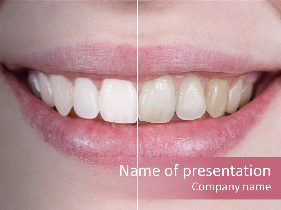 A Woman's Smile Before And After Dental Treatment PowerPoint Template