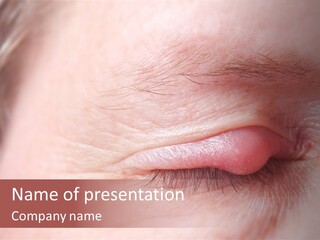 Eye Hail Germs PowerPoint Template