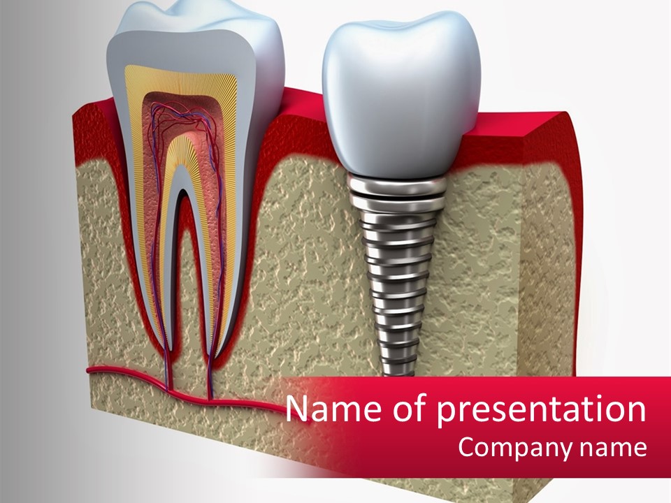 A Tooth With A Dental Implant On Top Of It PowerPoint Template