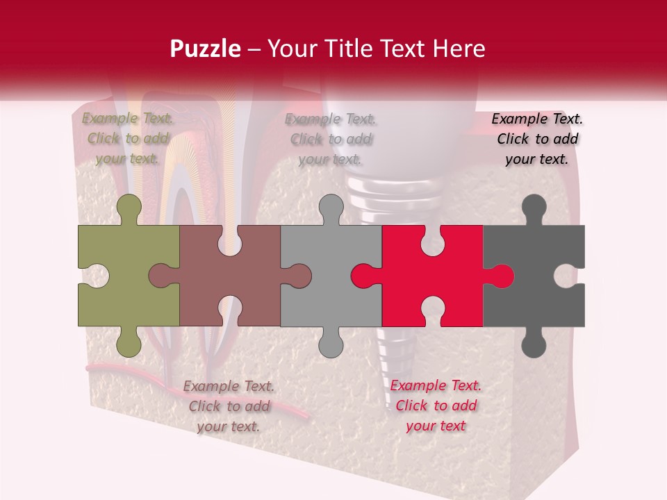 A Tooth With A Dental Implant On Top Of It PowerPoint Template