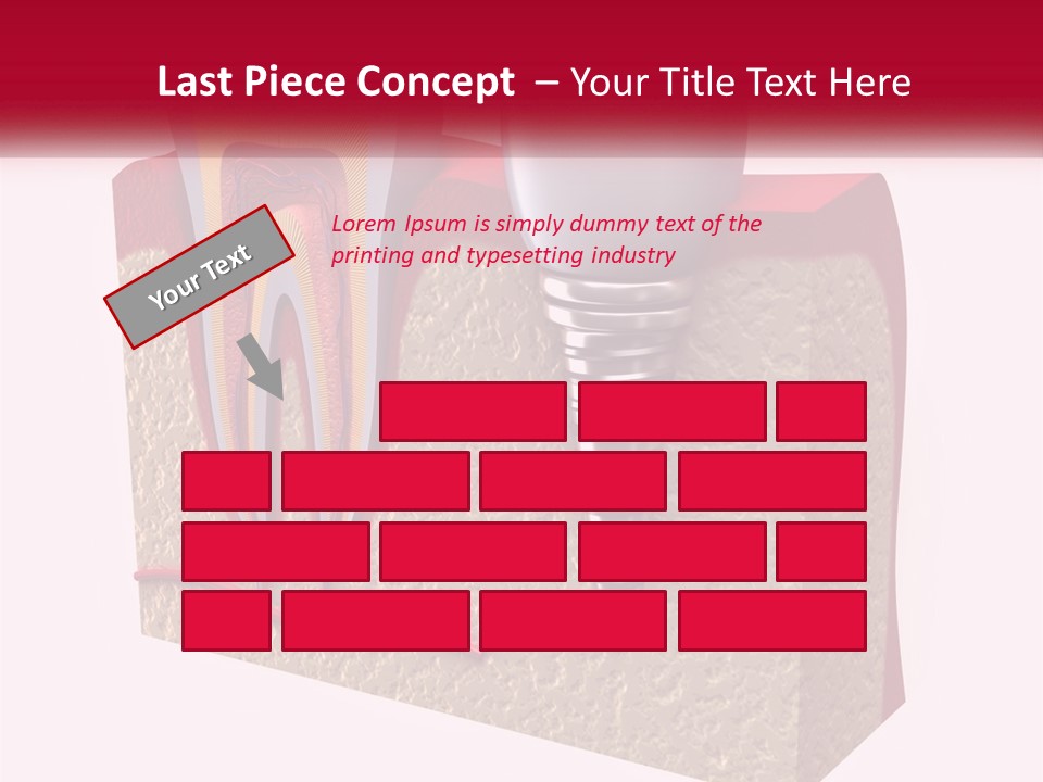 A Tooth With A Dental Implant On Top Of It PowerPoint Template