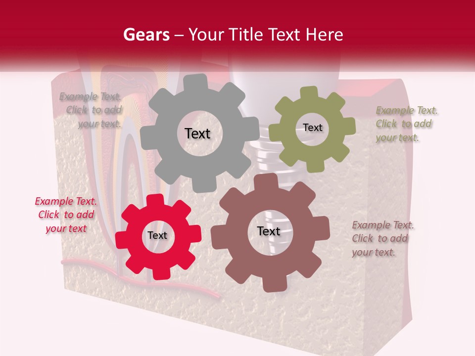 A Tooth With A Dental Implant On Top Of It PowerPoint Template