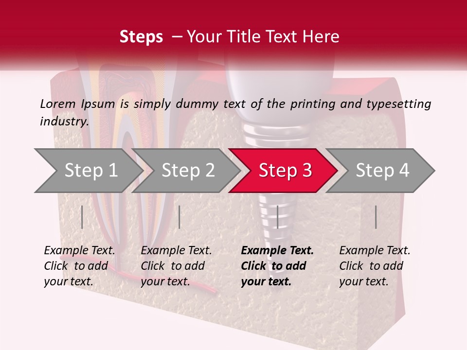 A Tooth With A Dental Implant On Top Of It PowerPoint Template