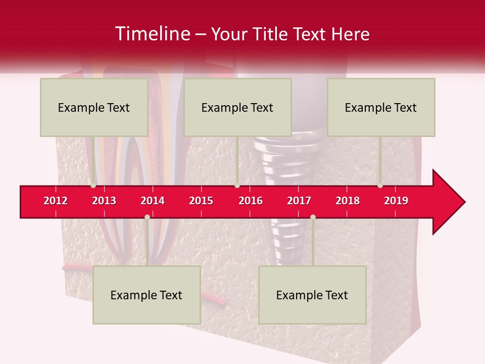 A Tooth With A Dental Implant On Top Of It PowerPoint Template