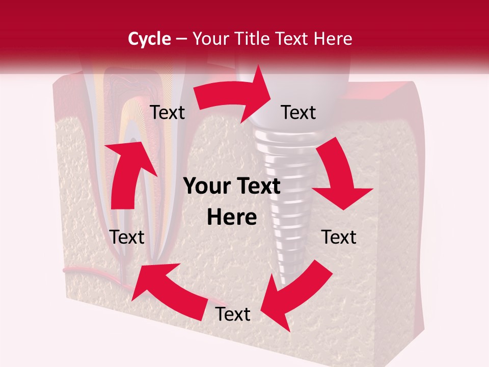 A Tooth With A Dental Implant On Top Of It PowerPoint Template