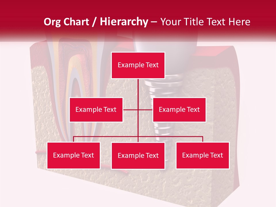A Tooth With A Dental Implant On Top Of It PowerPoint Template
