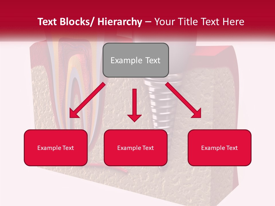 A Tooth With A Dental Implant On Top Of It PowerPoint Template