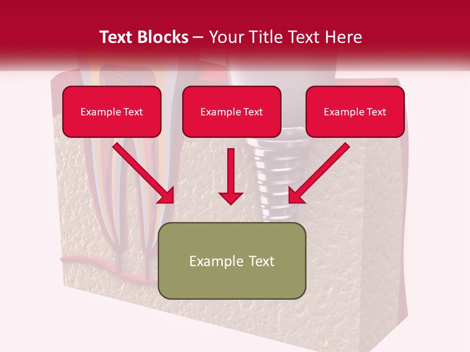 A Tooth With A Dental Implant On Top Of It PowerPoint Template